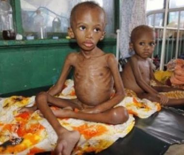 MSF OVERWHELMED AS ADMISSION OF SEVERELY MALNOURISHED CHILDREN SPIKES 100% IN NORTHERN NIGERIA